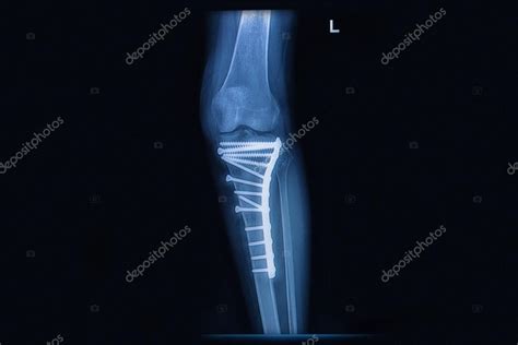 Radiografía De Fractura Tibia Hueso De La Pierna Hueso Tibia Con