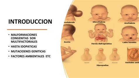 Malformaciones Congenitas Del Snc Eloy Udocz