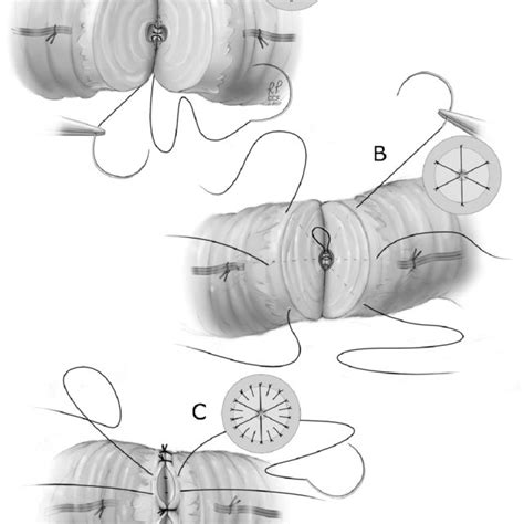 Modified two-layer vasovasostomy. | Download Scientific Diagram