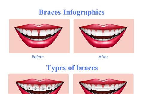 Teeth braces types infographic | Types of braces, Teeth braces, Glossy lips