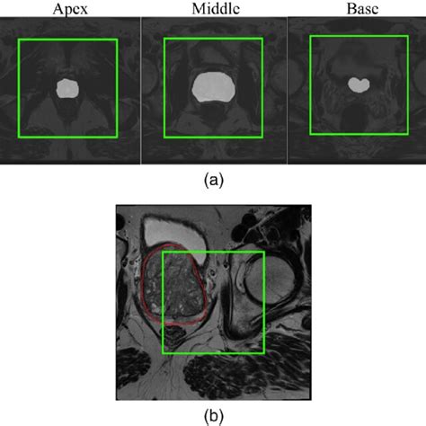 Slices Through The Apex Middle And Base Of The Prostate For A Download Scientific Diagram