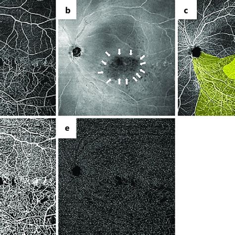 Representative Images Of Wide Field Octa A And En Face Oct B