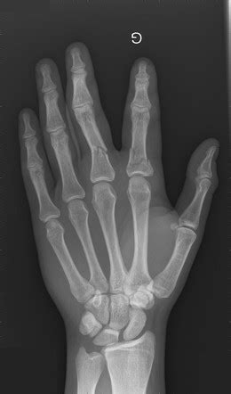 Intra Articular Fractures Of The Proximal Phalanx Distal End Images