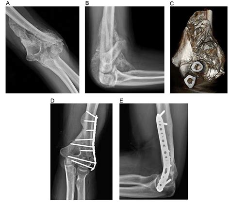 Figure 1 From Articular Osteotomy Of The Distal Humerus And Excision Of