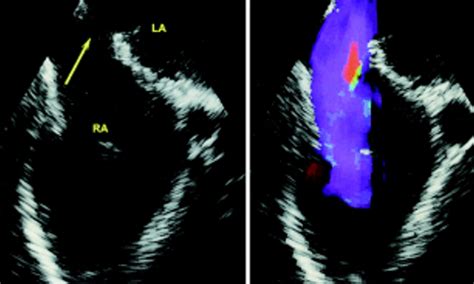 Echocardiography In Adult Congenital Heart Disease Heart