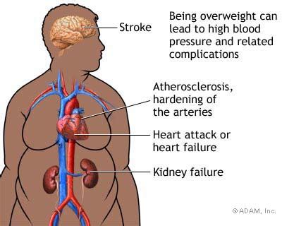 Diseases - Circulatory System