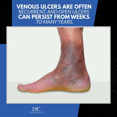 Venous ulcer, also known as stasis... - Laser Vascular Center