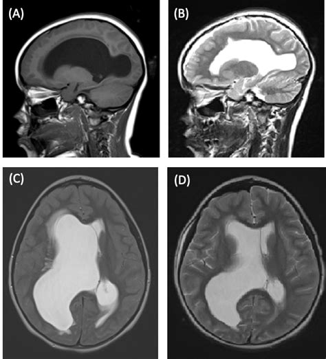 Noncommunicating Obstructive Hydrocephalus Consultant360