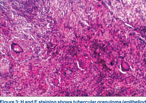 Figure From Miliary Pulmonary Tuberculosis With Tuberculosis