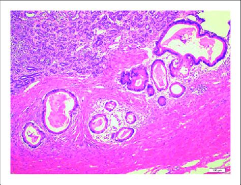 Retiform Pattern Sertoli Cell Tumor In Mucinous Epithelial Areas Â100