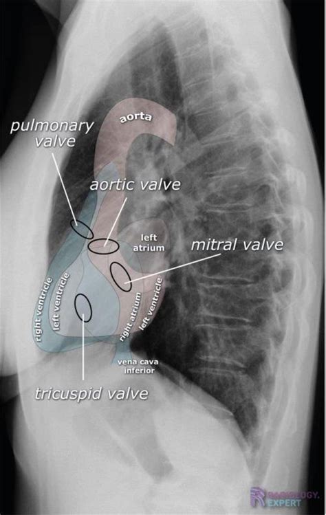 Chest X Ray