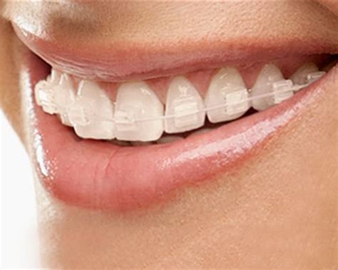 Clarity Advanced Ceramic Brackets Ortodoncia Estetica Dental