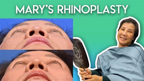 Mary S Rhinoplasty Journey YouTube