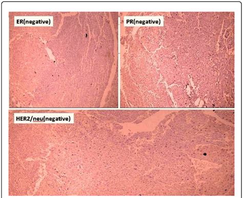 Ihc Staining Negative For Estrogen And Progesterone Receptors And Download Scientific Diagram