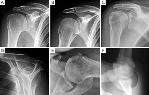 More Frequent Radiographs In Shoulder Instability A Straight Ap