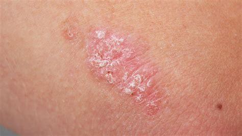 What Are The Early Warning Signs Of Psoriatic Arthritis First For Women