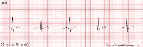 Ecg Ekg Practice Quiz Identify Rhythms