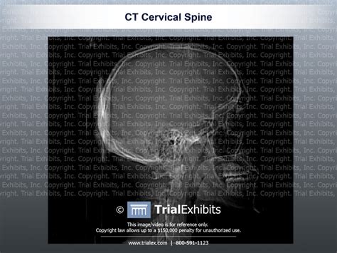 Ct Cervical Spine Trial Exhibits Inc