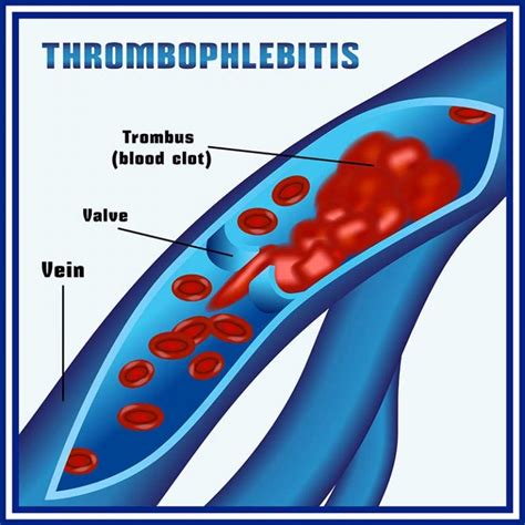 The Truth About Blood Clots; Warning Signs & Symptoms