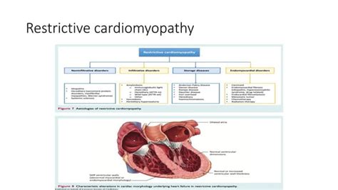 Echo In Restrictive Cardiomyopathy Ppt