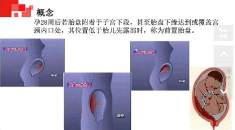 【ppt】前置胎盘护理查房ppt查房胎盘前置护理 健康界