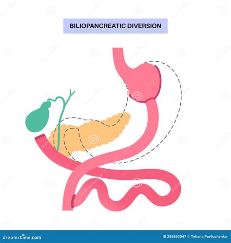 Biliopancreatic Diversion Procedure Stock Vector Illustration Of