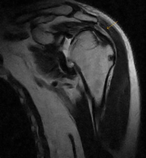 Recurrent Shoulder Dislocation Mri Sumers Radiology Blog