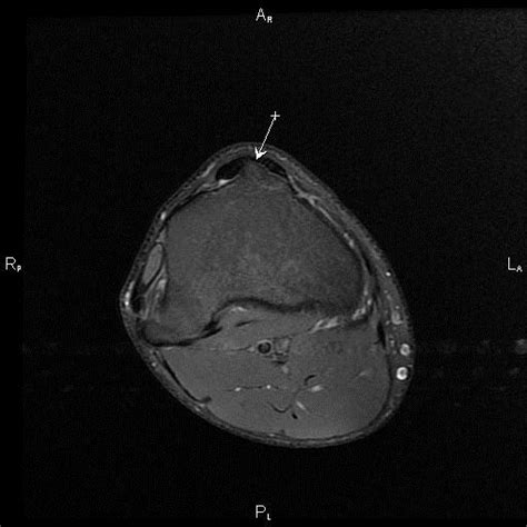 Болезнь Осгуда-Шляттера - НЦЗД