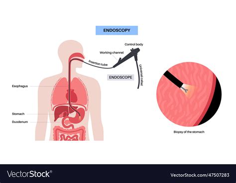 Gastroscopy Endoscopy Procedure Royalty Free Vector Image