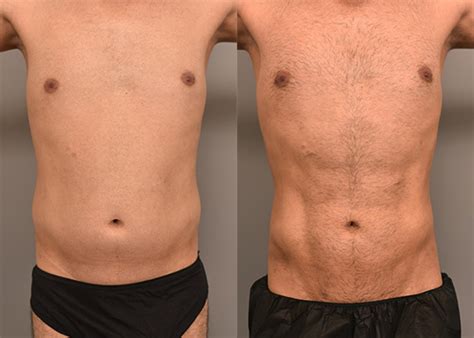 What Is Liposuction Recovery Like Thomas P Sterry MD