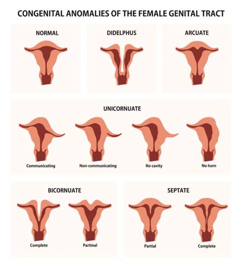 Uterine Anomalies Ob Gyn New York Gynecologists In New York