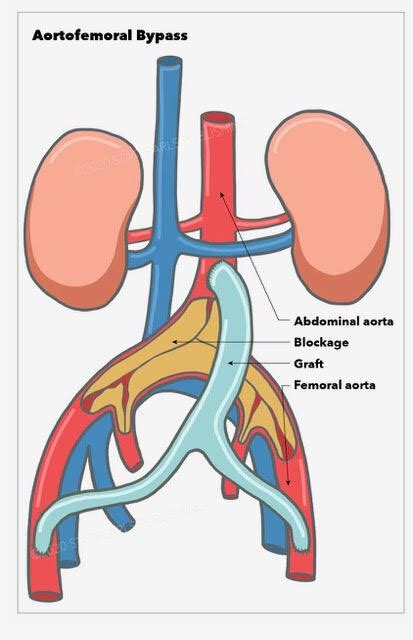 [figure Aortofemoral Bypass Abdominal Aorta Blockage Graft Femoral