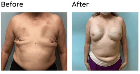 Best Atlanta Revision Of Breast Reconstruction Surgeon Near Me