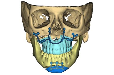 Technologies To Improve Outcomes In Facial Deformities From Tmj Penn