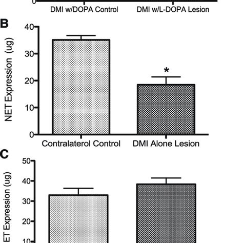 Dyskinesia Over Time With L Dopa Versus L Dopa Dmi Treatment A