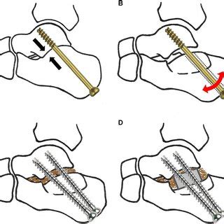 a Subtalar arthrodesis is performed using a large diameter partially ...