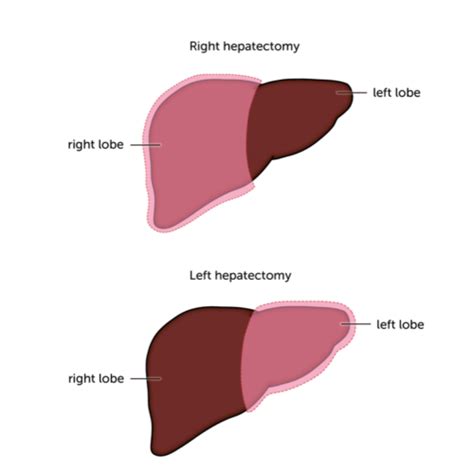 Types Of Surgery Liver Cancer Uk