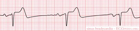 File Rhythm Sinusbradycardia Png ECGpedia