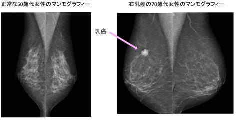 当院の乳がんの診断 乳腺外来に行ったらどんなことをするの？ 胸部・乳腺外科 診療の最前線 高松赤十字病院 日本赤十字社 香川県