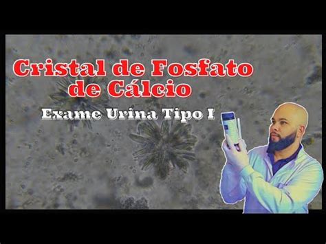 Cristais de Fosfato de Cálcio na Urina EAS Rotina Laboratórial