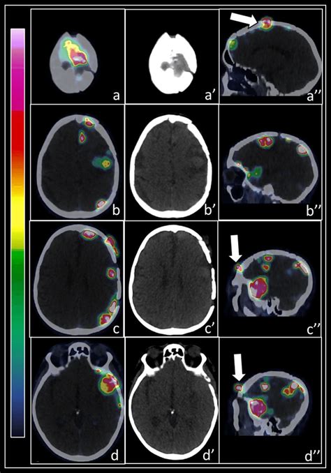 A 70 Year Old Patient With Multiple Meningiomatosis Already Submitted