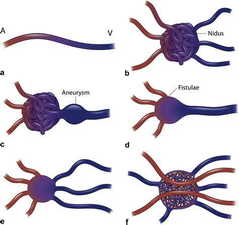 Endovascular Treatment Of Arteriovenous Malformations Of The Head And