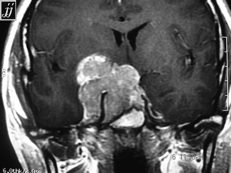 Parasellar Meningioma Radiopaedia