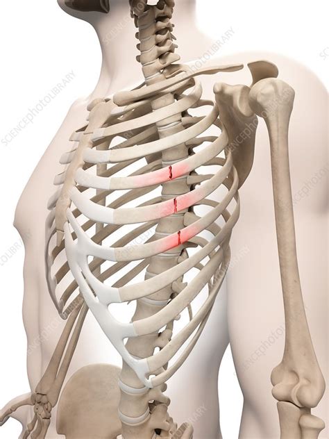 Broken ribs, Illustration - Stock Image - F012/7022 - Science Photo Library