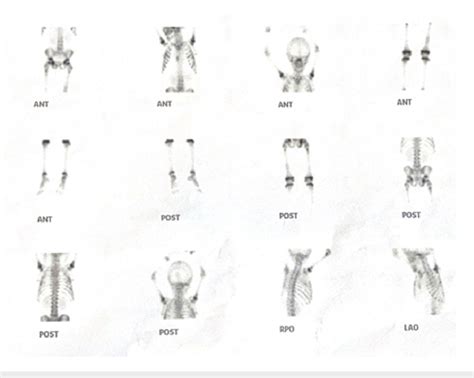 Whole Body Bone Scan Tc M Mdp Depicting Inhomogeneous Tracer