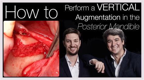 Khoury Technique Vertical Bone Augmentation In The Posterior