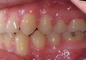 Braces Before After Dubbo Orthodontic Centre