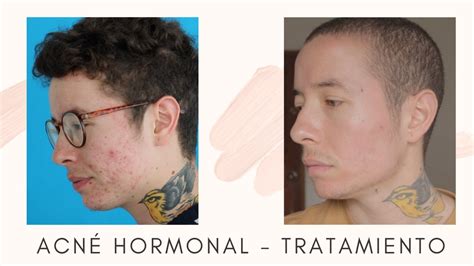 Acné Hormonal Tratamiento Ftm Youtube