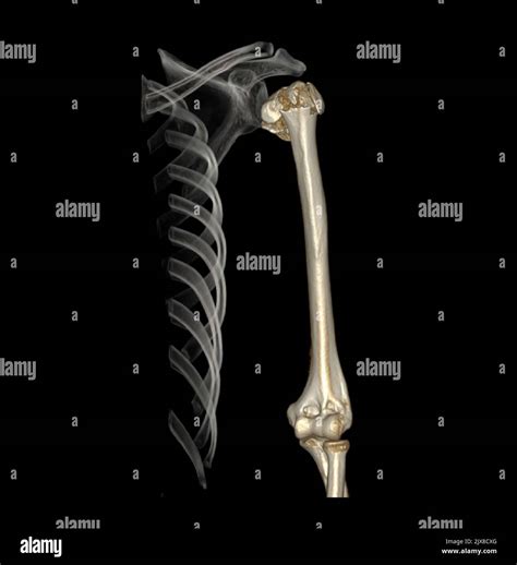 Computed Tomography Volume Rendering Examination Of The Shoulder Joint