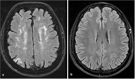 Figure 1 Brain Mri Axial T2 Tirm Image A In A Patient With Ah